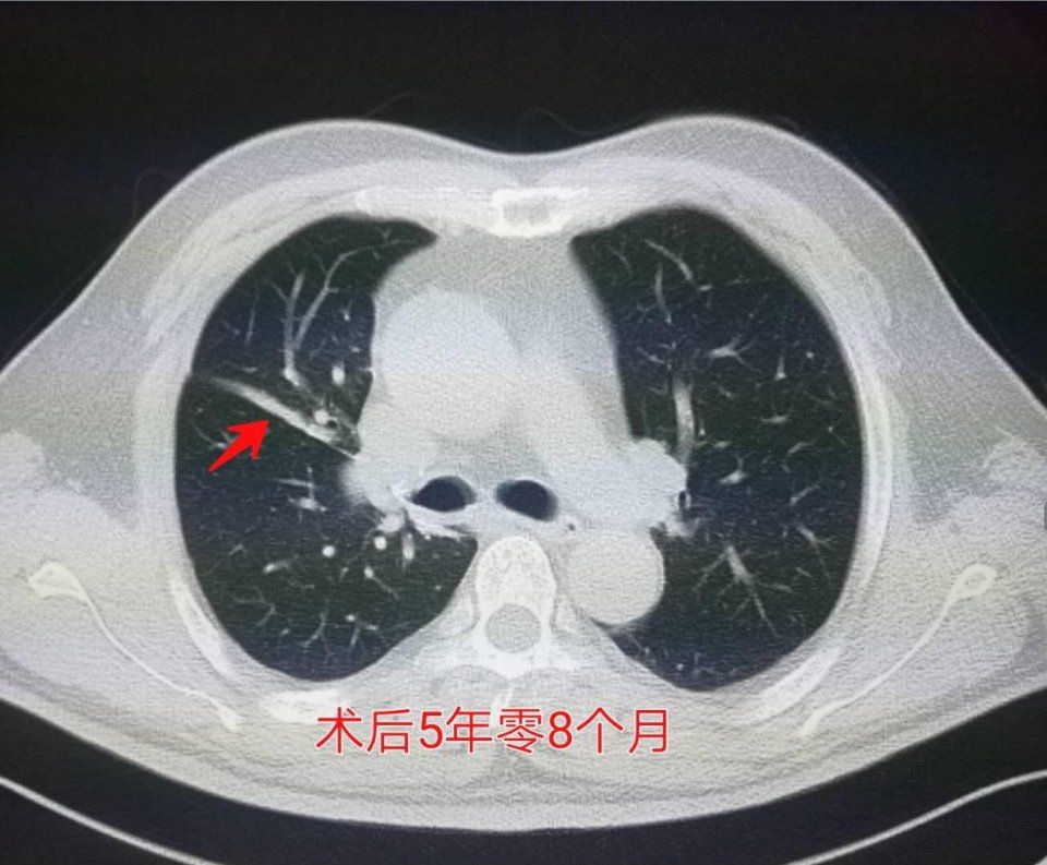 女子查出肺结节不重视成肺癌晚期