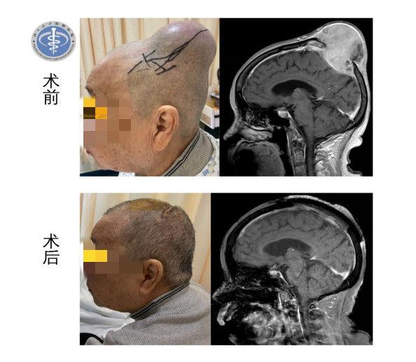 车祸后CT查出脑瘤医生没告知?