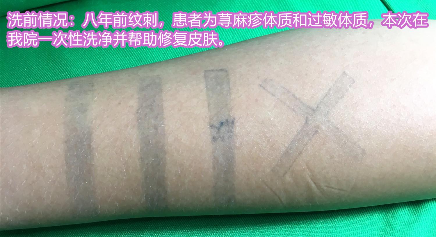 百元文身清洗费用飙升背后的故事，76万元天价背后的真相与法规解读