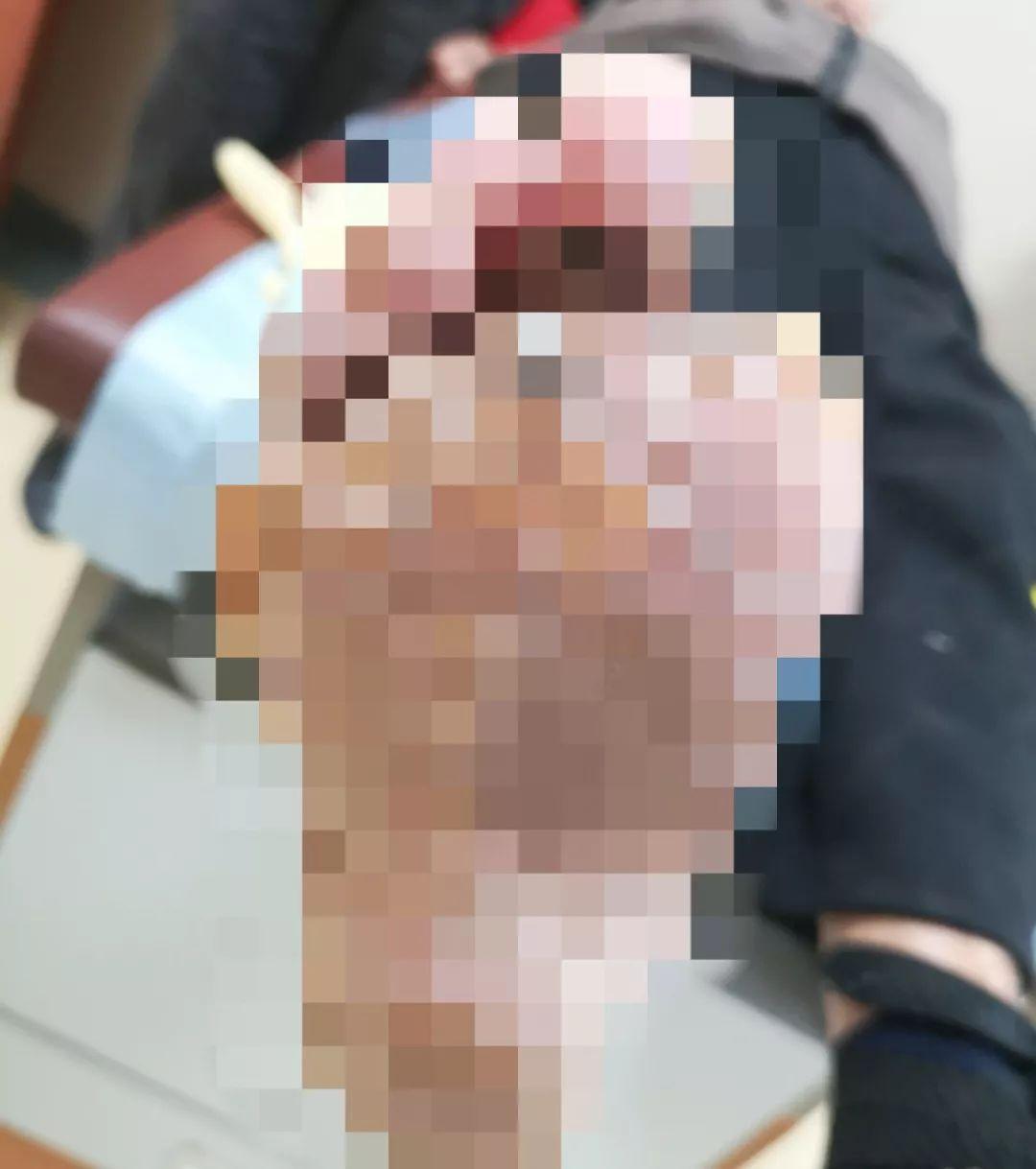 男子足疗店修脚遭遇惊魂瞬间，感染危机竟致截肢保命！